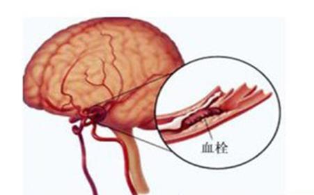 当身体出现症状,说明脑血管要堵塞了,尽快去医院