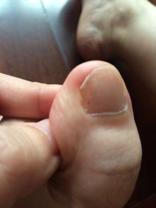 这个是什么 上次也长过 指甲盖里有个黑点 但是指甲长长以后我剪掉了,现在又有了 到底怎么会这样的 