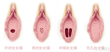 为什么妇科医生拒绝做处女膜修复手术