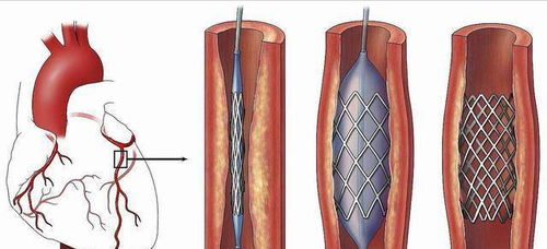 心脏支架后做到这3点,保证血管长期通畅,您能做到吗