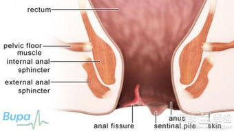肛裂一直不好怎么办