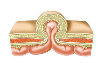 切口疝气复发的症状
