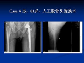 天津市医疗保险和商业保险哪个可以报销股骨头置换手术的相关费用？！报销多少？！