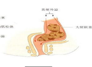 大便失禁,大便失禁如何治疗,大便失禁的症状 外科 肛肠科 寻医问药 xywy.com 