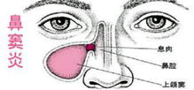 鼻窦炎的病因有哪些 重庆铭仁耳鼻喉医院来解答