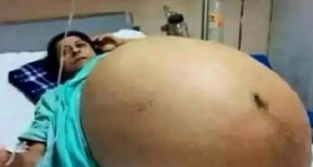 女生怀孕肚子疯狂变大,无锡女子肚子变大，似怀胎十月！一检查竟是30多斤的大肿瘤