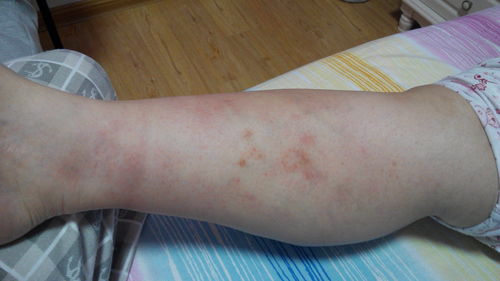 白血病瘀斑与普通瘀斑图片,白血病大腿出现瘀斑,斑点是