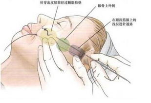 埋线减肥有效吗 埋线术后专用 模特内宫 预防反弹的原理 