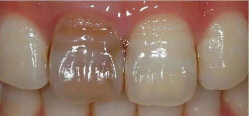 牙齿折断不是应该补上去吗，为什么要做根管治疗(牙齿折断算脱落吗)