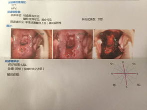 做完宫颈糜烂手术流血好像月经那么多正常吗