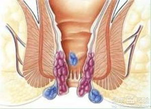 不良习惯引起痔疮