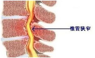 美国很早就有一种治疗椎间盘突出的技术了，叫DST(椎间盘再生治疗)，我们什么时候能引进？