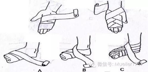 运动损伤的急救方法 