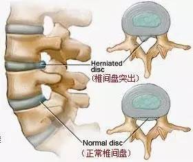 腰间盘突出会导致瘫痪