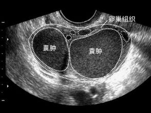 卵巢巧克力囊肿破裂？卵巢巧克力囊肿破裂怎么办