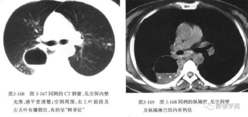 肺部空洞病灶的影像诊断