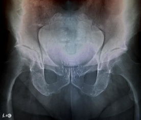 前列腺结石的4个危害,容易酿成前列腺问题 