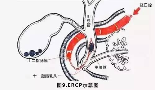 ERCP是什么意思 