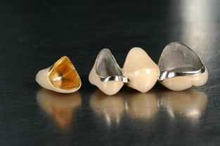 牙齿意外断裂怎么办 专家称 牙齿断裂只能采用冠修复 