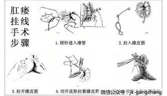 我的肛瘘已经有好几个月了，由于工作我现在不方便做手术，请问最多能拖延多久