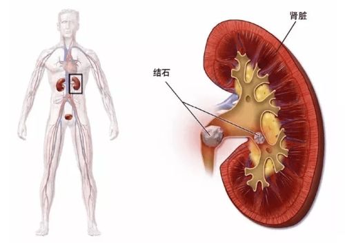得了肾结石,饮食禁忌那么多 看过这篇文章,一下就清楚了