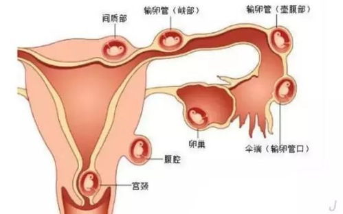 32岁孕妈怀了双胞胎 一个宫内孕,另一个宫外孕