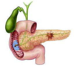 胰腺不好,需戒掉这三种食物,小心胰腺癌找上门 