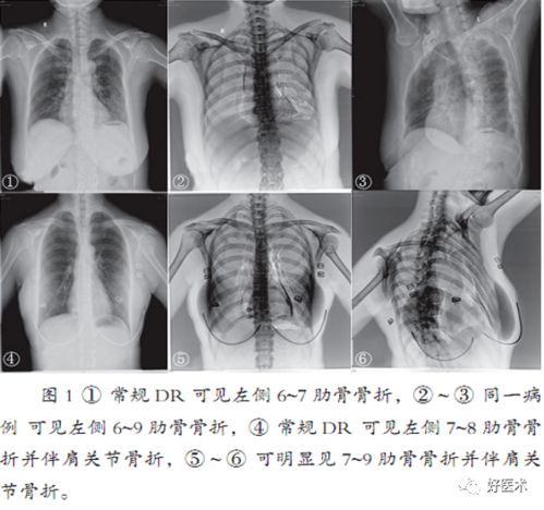 打高尔夫肋骨痛怎么办,打高尔夫胸疼怎么办