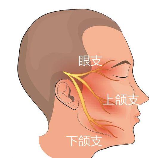 右侧面部疼痛吃药 伽玛刀 射频治疗8年总是反反复复,还能怎么办