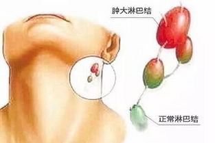 首大计成 当颈部肿物时诊断要注意哪些因素