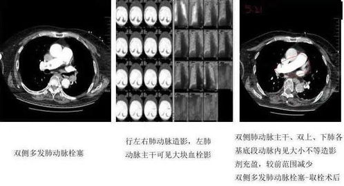 超声波提示；左侧股总，股浅，胭腘静脉内低回声是什么意思？