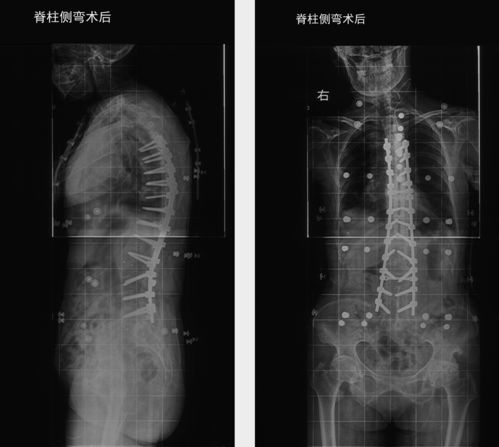 陶惠人教授 老年性脊柱侧弯手术案例展示