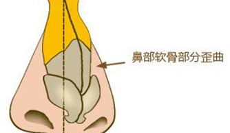 武汉哪些人不适合做歪鼻矫正