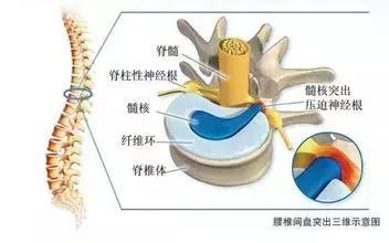 腰椎间盘突出症有哪些症状