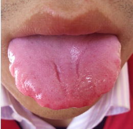 舌头上有齿痕,是什么原因引起的 