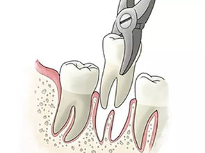 口腔科普丨哪种情况的牙齿松动了可以挽救,哪种情况留不住