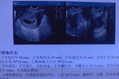 怀孕1个月清晰b超图（怀孕1个月胎儿图有多大）