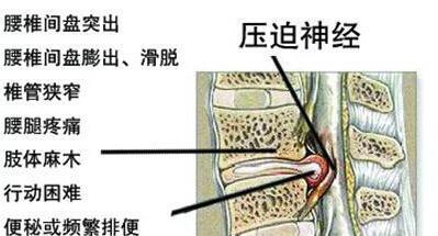 十腰九疼 一斤盐,打败专家,腰间盘突出治一个好一个