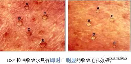 你确定你长的是痘吗 这套祛痘方案,还你嫩白肌肤