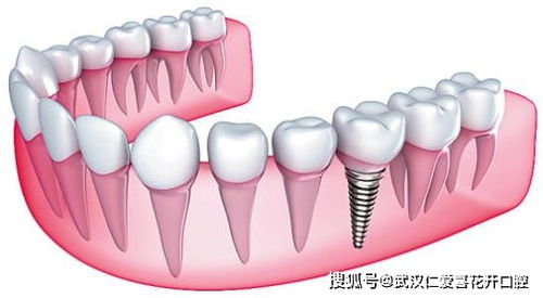 牙齿修复最重要的手段便是 种植牙 钛合金材料与人体相容性高吗