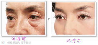 广州祛眼袋手术有风险吗 什么方法去眼袋好