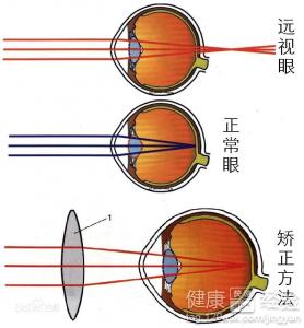 3种远视眼症状早知道矫正远视要注意哪些问题