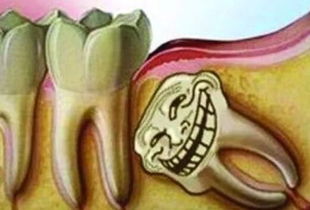 来自灵魂深处的发问 智齿到底要不要拔