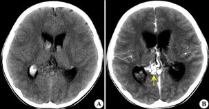 双侧侧脑室动静脉畸形 CT病例图片影像诊断 影像园 