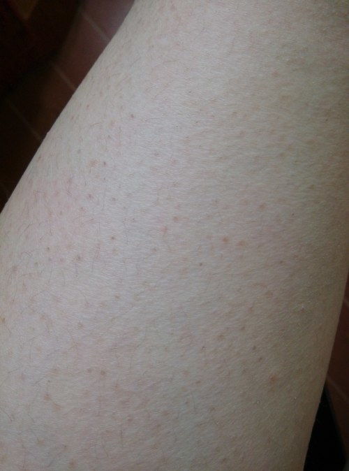腿上很多小黑点,是不是毛孔堵塞 怎么办 