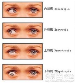 斜视都有哪些种类