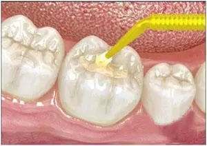树脂补牙的效果怎么样 它有哪些优点呢