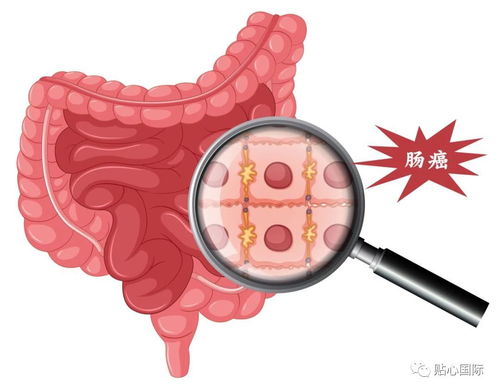 肠炎与肠癌最明显区别 肠炎与肠癌有什么区别