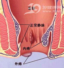 警惕 加班男人易多发痔疮