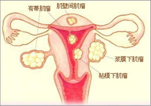 女性经期不适你还在置之不理 小心越发严重 